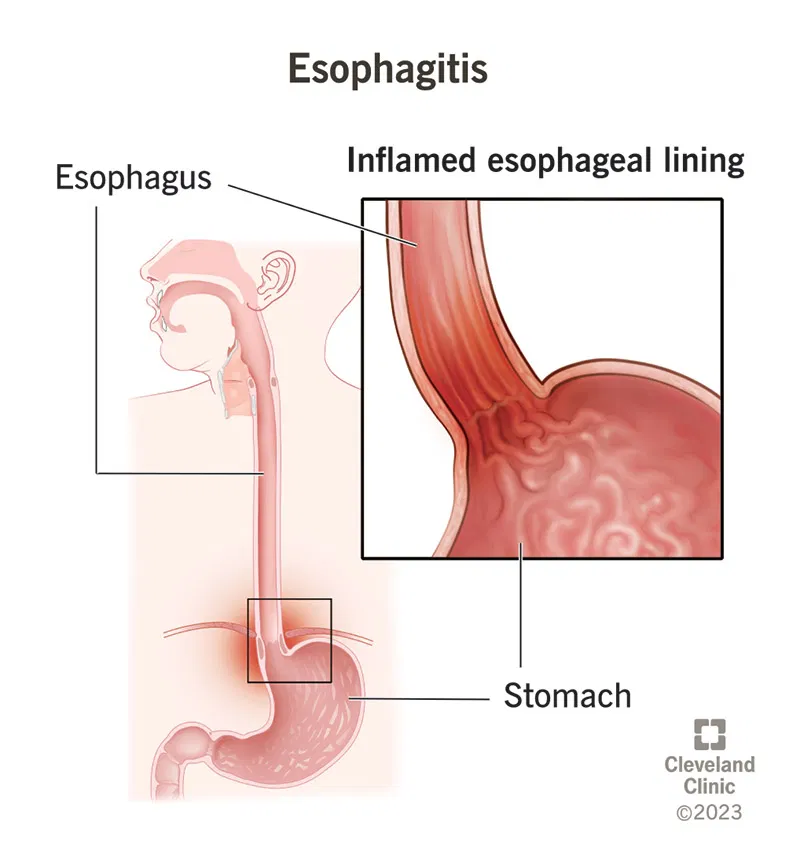 What Is Esophagitis? Symptoms, Causes, and Treatment