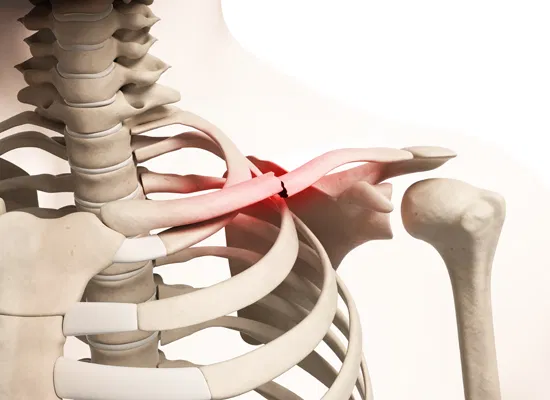Clavicular Fracture: Symptoms, Causes & Recovery Time