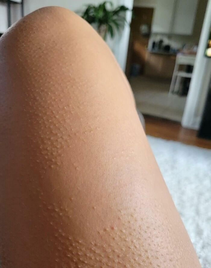 Patch On Her Leg That Doesn t Get Goosebumps