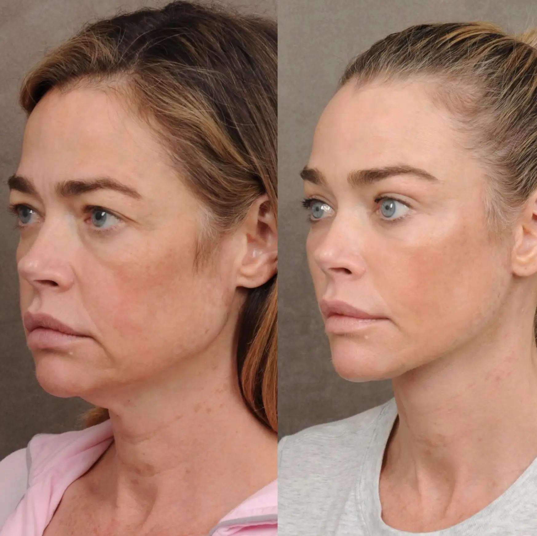 1774193606532_aHR0cHM6Ly9ldS1pbWFnZXMuY29udGVudHN0YWNrLmNvbS92My9hc3NldHMvYmx0Y2Q3NGFjYzFkMGE5OWYzYS9ibHQ3OTQ2ZGU1ODE2NTg5YTZmLzY5YmZjMDdmM2U4NWQ3NzZkNDA2ZWNjNi9kZW5pc2UtcmljaGFyZHMtZmFjZWxpZnQtcmVzdWx0cy5qcGVn